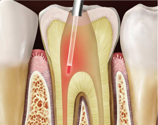 ما هو علاج جذور الأسنان بالليزر؟